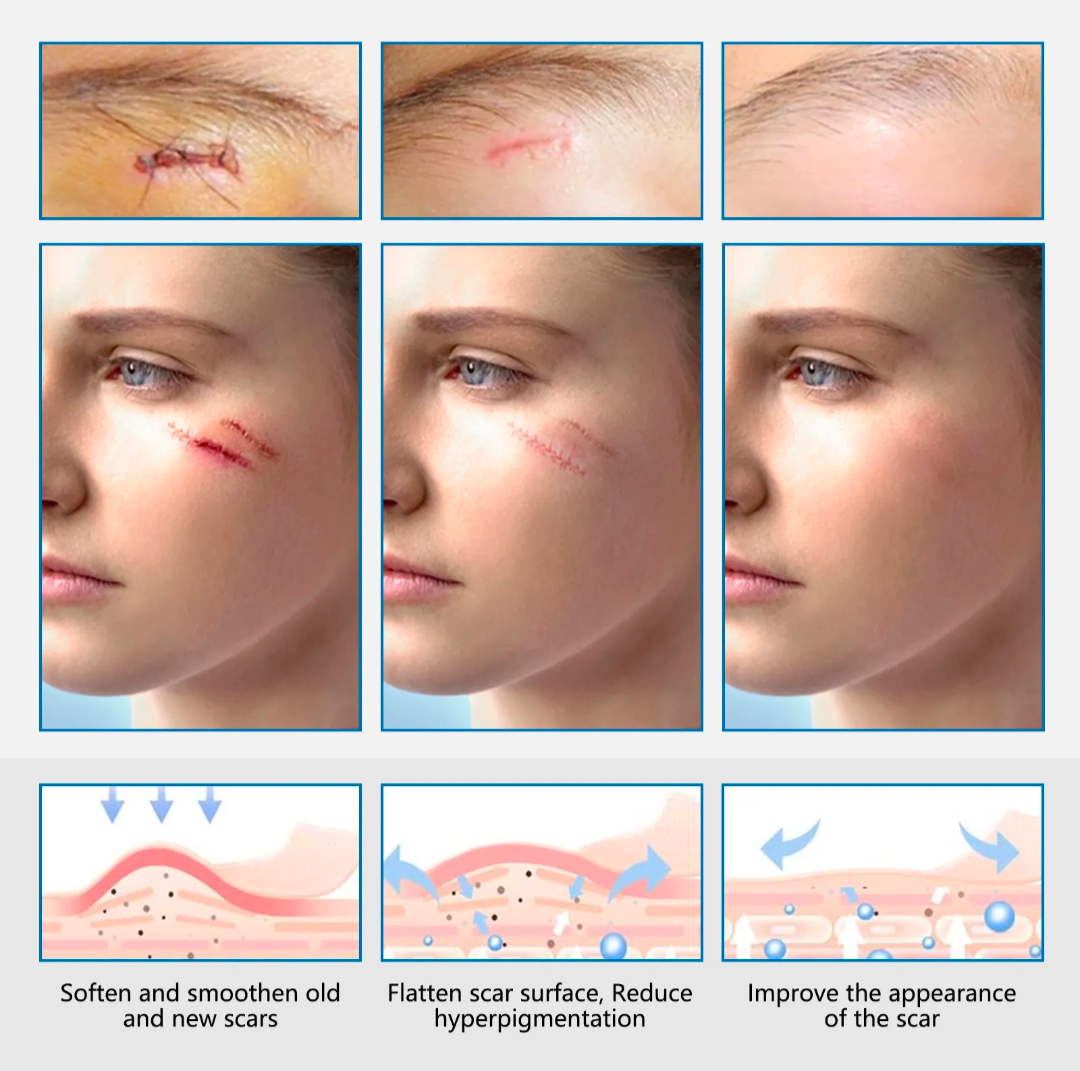 Scar Therapy Medical Grade Silicone Tape